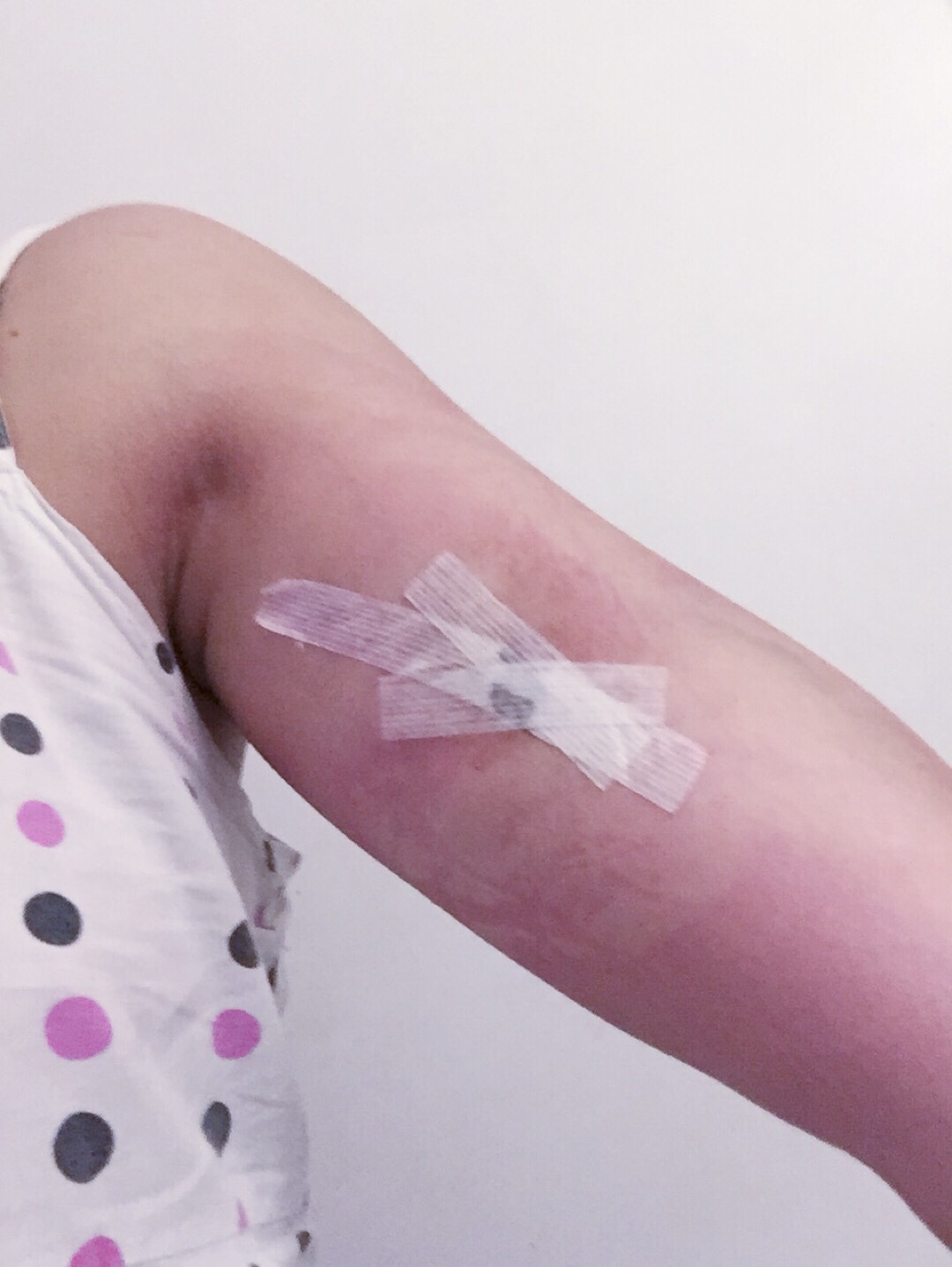 what is the icd-10 code for removal of nexplanon implant